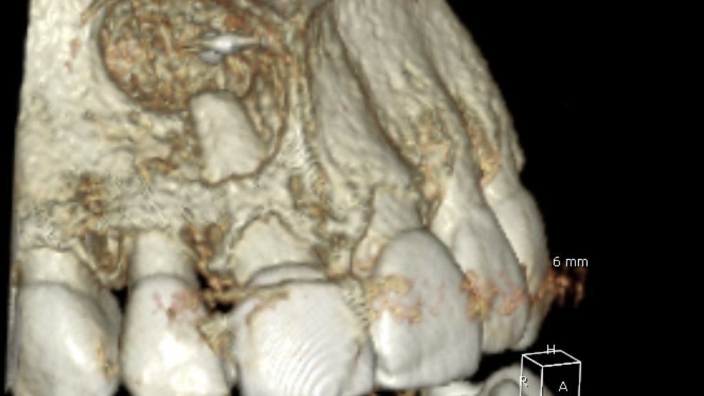 CBCT rendering of a maxillary cyst
