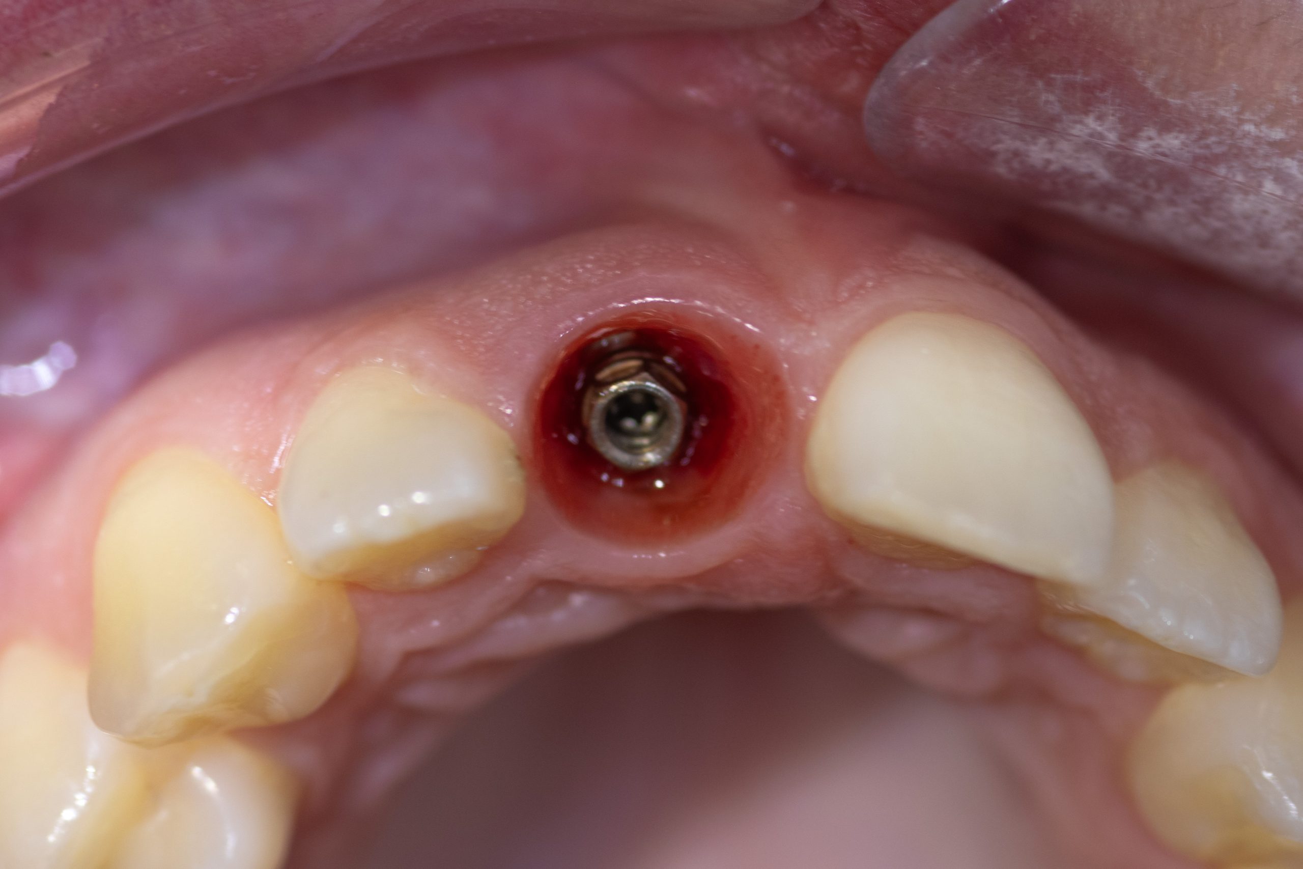 Socket Shield Technique allows for perfect Pink Aesthetic Score