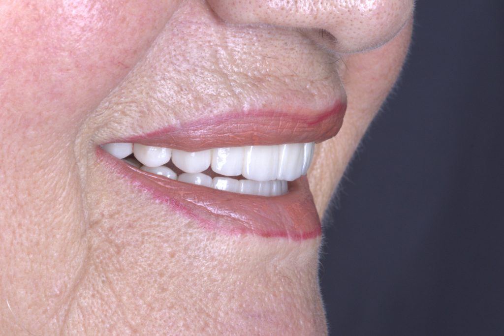 Beautiful smile restoration