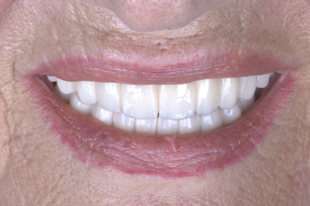 Full contour Zirconia