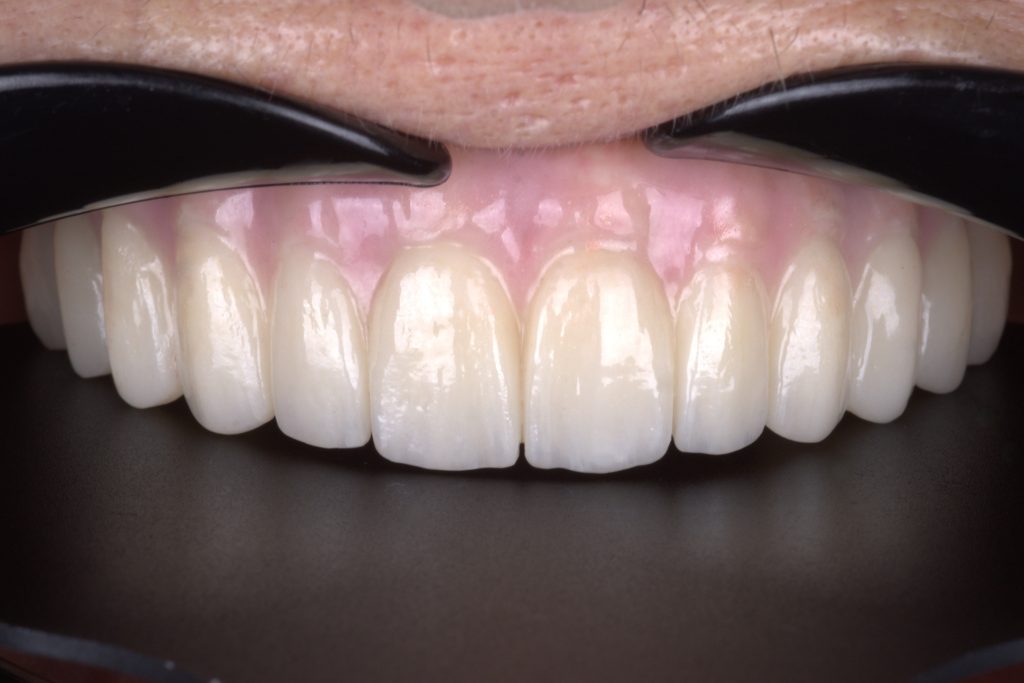 Transparent incisal edge