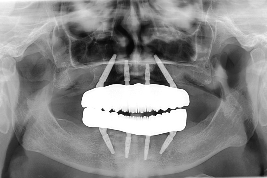 All on 4 panoramic scan of final fixed prosthesis
