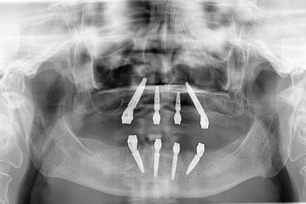 All on 4 neodent implants panoramic scan