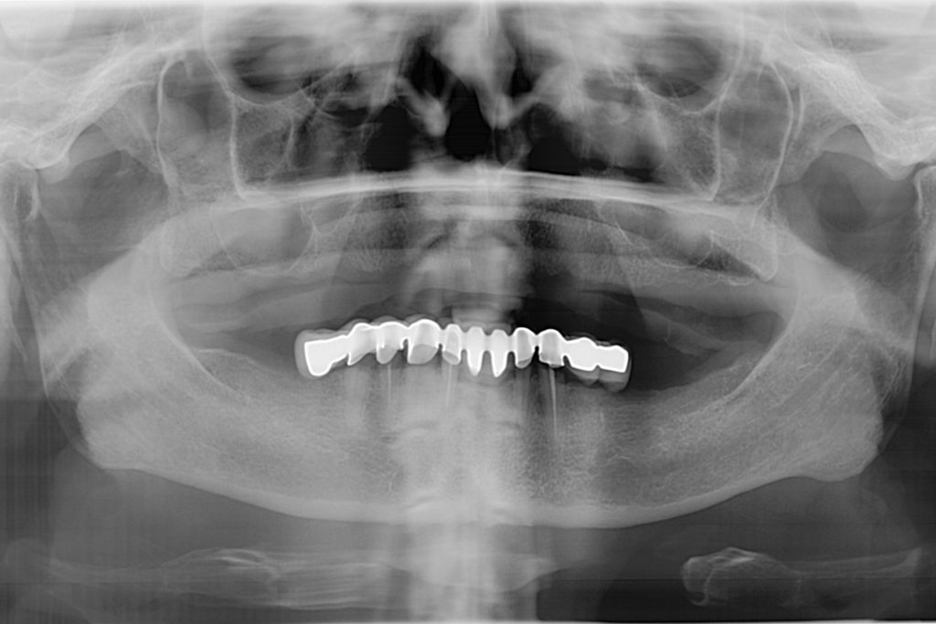 Panoramic scan before All on 4 treatment