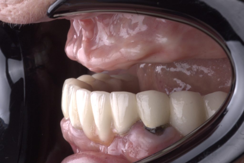 poor PFM bridge in lower jaw