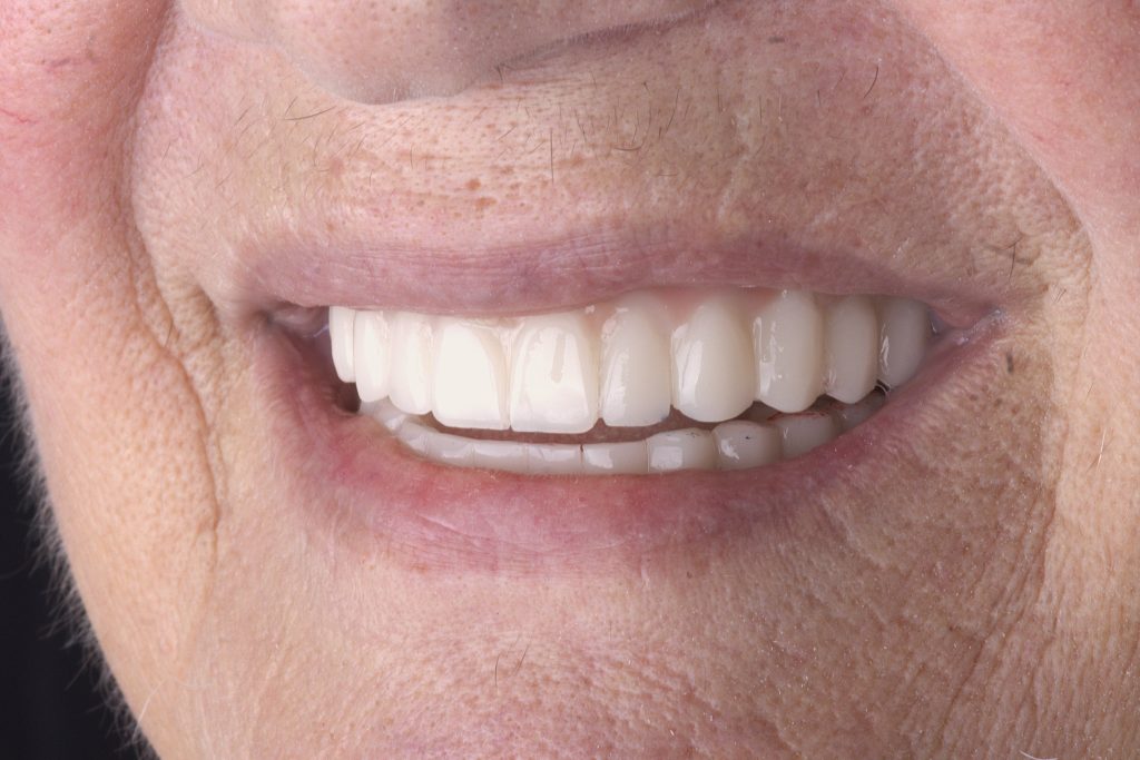 PMMA temporary fixed bridge on implants