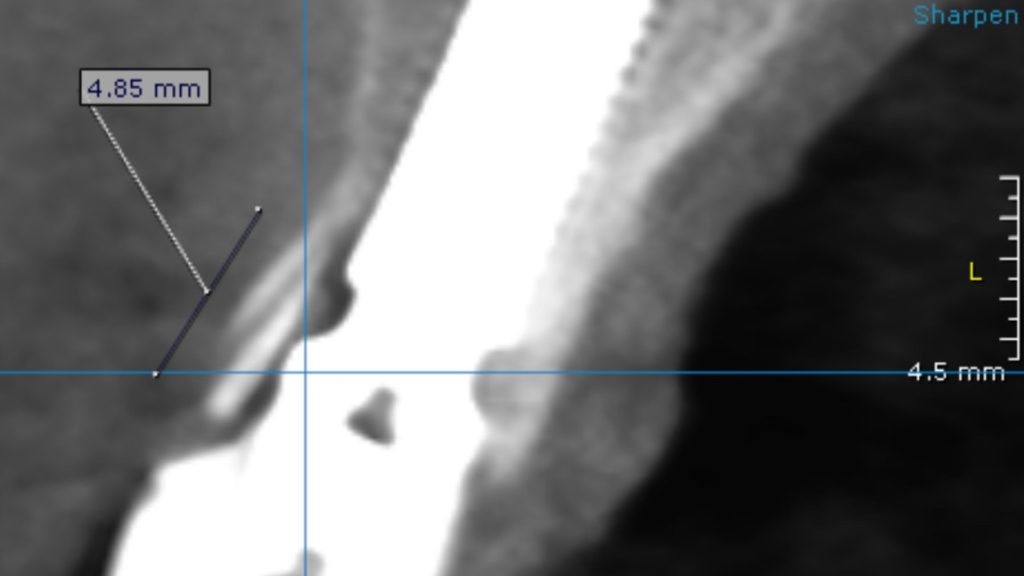 CBCT showing Socket Shield