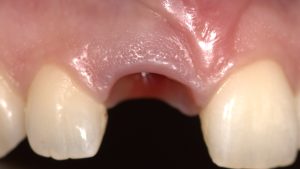 Socket Shield Technique - Graft Free Implantology Perfect Natural Gingival Zenith