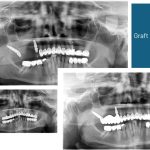 Use of pterygoid implants to restore posterior segment without sinus lift
