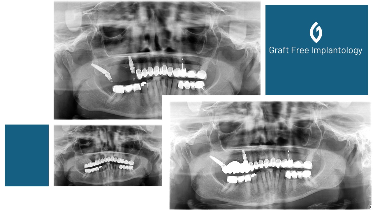 Use of pterygoid implants to restore posterior segment without sinus lift