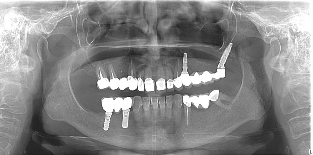 To avoid sinus floor, pterygoid implants can be used quickly and safely and even accommodate immediate loading.