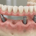 All on 4 full arch restoration