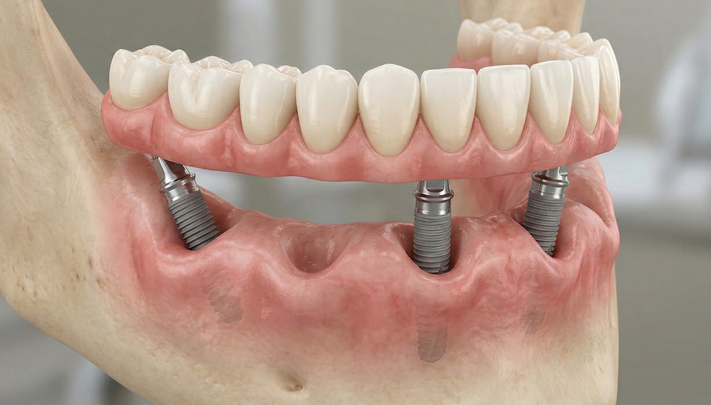 All on 4 full arch restoration