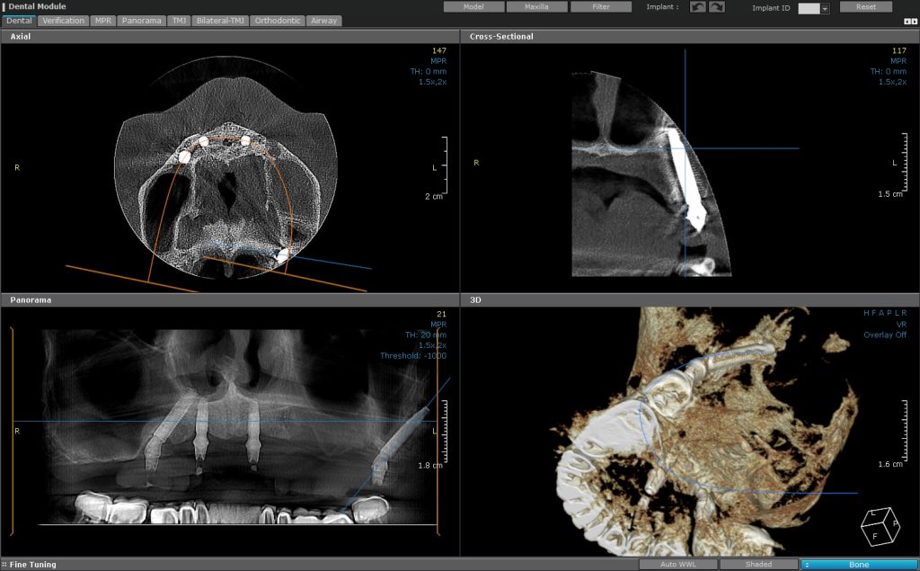 CBCT analysis of a pterygoid implant showing the anchorage in sphenoid and palatal bone