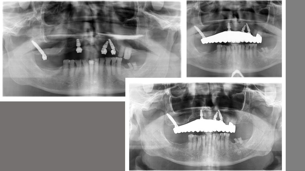 Pterygoid implant was used as there was no other option. The long span of restoration is a risk, but remains stable.