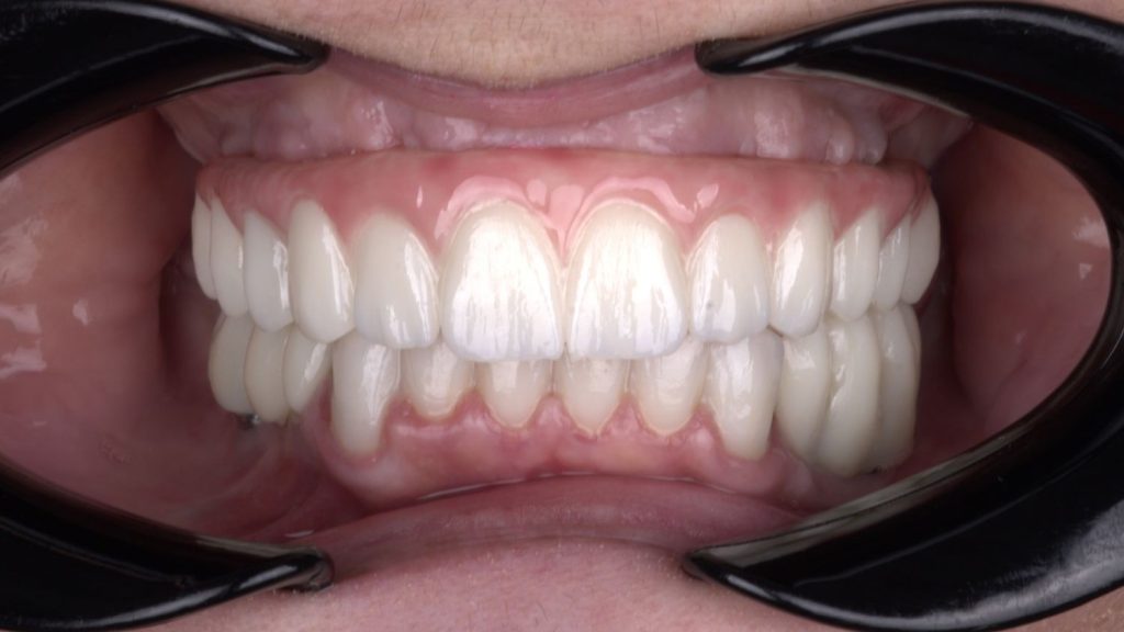Hidden transition of natural to artificial gingiva.