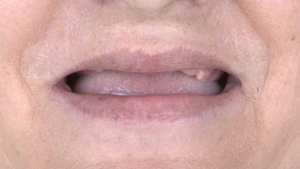 Elongated alveolar crest of edentulous patient.