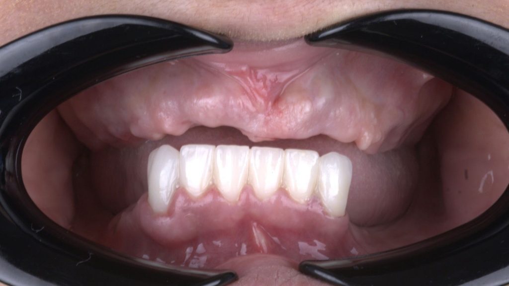 Uneven edentulous jaw is indication for crest nivelation or bone reduction as parto of the All-on-4 protocol.