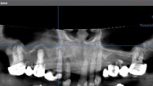 Preoperative maxilla with failed dentition