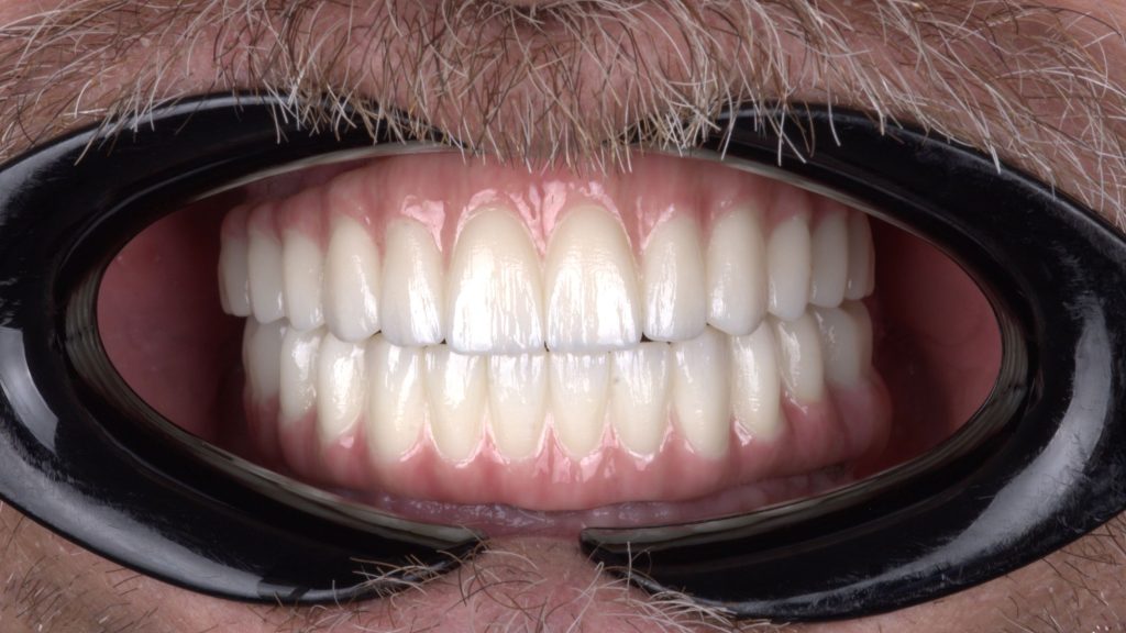 Double All-on-4 monolithic Zirconia restoration