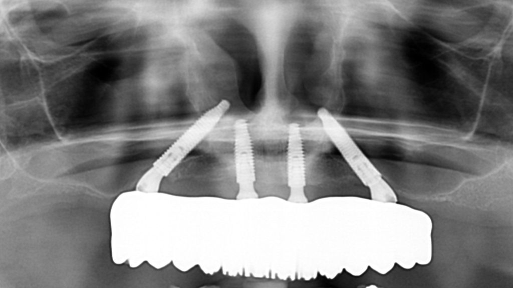 Control Panoramic x-ray scan of successful trans-sinus dental implants one year after surgery.