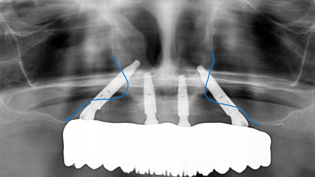 Sinus floor and wall marked showing the route of trans-sinus dental implants.