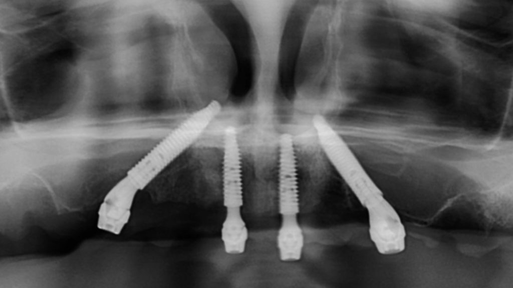Postoperative Panoramic scan of trans-sinus dental implants