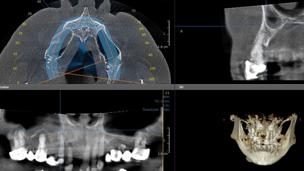 Preoperative CBCT of maxilla with large maxillary sinus extensions