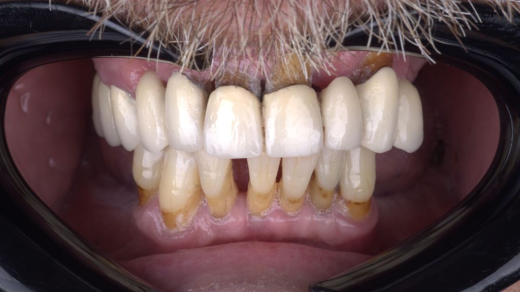 Advanced periodontal disease