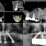 Expanding AP spread with trans-sinus dental implants