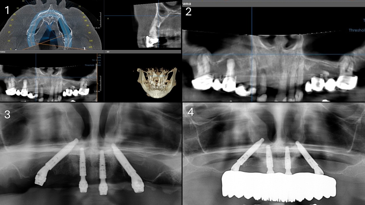 Expanding AP spread with trans-sinus dental implants
